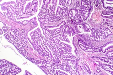 Colon adenocarcinoma, light micrograph, photo under microscope