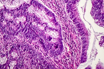 Colon adenocarcinoma, light micrograph, photo under microscope