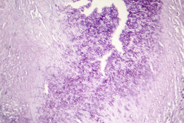 Aortic atherosclerosis, light micrograph, photo under microscope