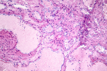 Hepatic cavernous hemangioma, a benign liver tumor, light micrograph, photo under microscope
