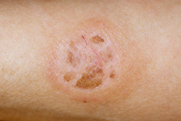 Dartre (lichen) on the skin of man. Infectious skin disease_