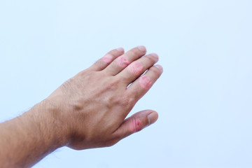 Rheumatoid arthritis of hands isolated on white background