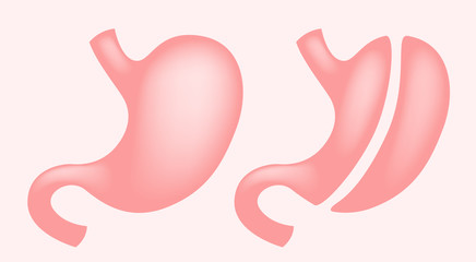 Laparoscopic Gastrectomy Gastric Sleeve / weight loss surgery vector