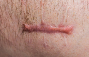A wounded on the human body, suture protracted old, deep cut, scar close-up, incision on the abdomen
