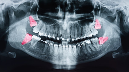 Growing Wisdom Teeth Pain On X-Ray - 223913289