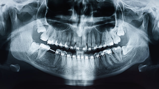 Dental X-Ray Photo Of Human Skull And Teeth With Braces