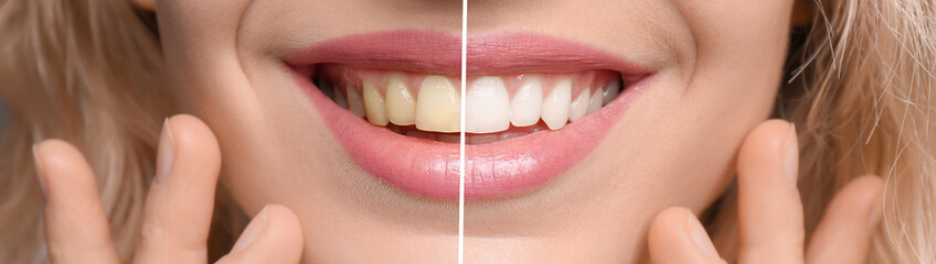 Smiling woman before and after teeth whitening procedure, closeup