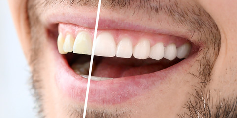 Smiling man before and after teeth whitening procedure, closeup