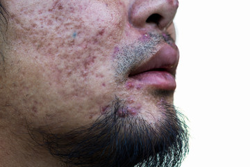 Men are pitted facial acne. select focus