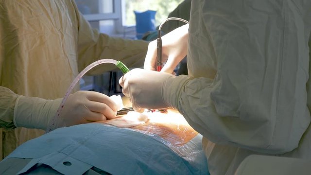 A team of doctors is performing an operation on the veins. Many specialists participate.