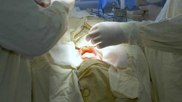 The surgeon operates on the patient. He sews the incision after the operation. Close-up.
