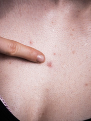 Woman having pimples red spots on chest