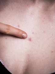 Fototapeta premium Woman having pimples red spots on chest