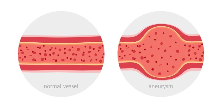 Healthy and sick aneurysm human vessel