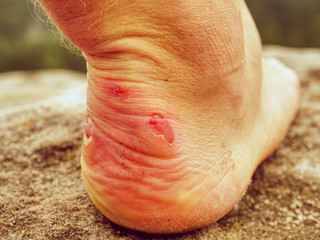 Man hiker sweaty legs with horrible painful callus resting on peak.