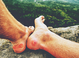Man hiker sweaty legs with horrible painful callus resting on peak.