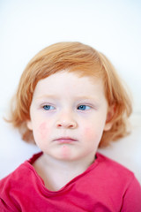 Fototapeta premium Allergies, atopic dermatitis on the face of a baby