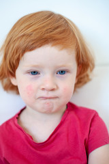 Allergies, atopic dermatitis on the face of a boy