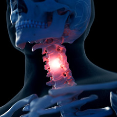 3d rendered medically accurate illustration of a painful neck