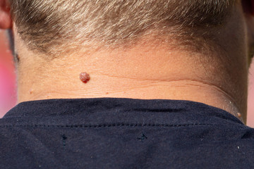 Naklejka premium Birthmark on the neck of a man