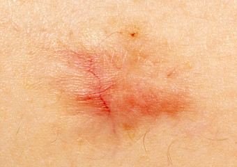 A wound on a person's skin as a background