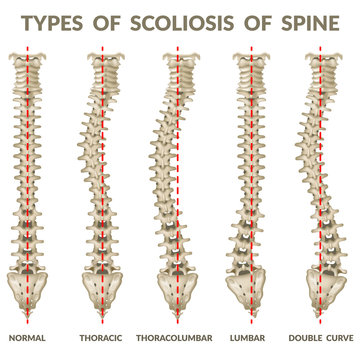 Infographics types of scoliosis of spine. Body posture defect. 3d realistic vector illustration on white background.