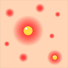 Acnes on skin. Vector. 