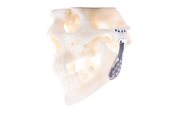 White 3D skull with titanium prostetics