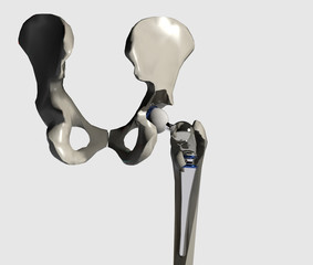 Installazione protesi dell’anca con femore, 3D rendering