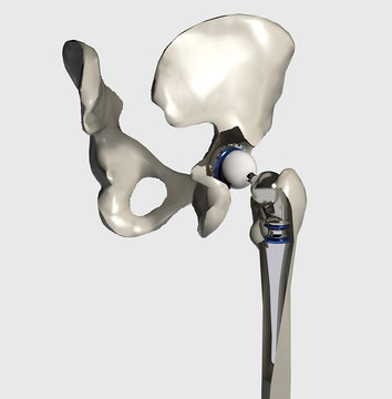 Installazione protesi dell&rsquo;anca con femore, 3D rendering