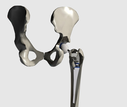 Installazione protesi dell&rsquo;anca con femore, 3D rendering
