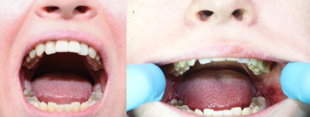 Before and after the operation to remove wisdom teeth - eights. Close-up of wisdom teeth and stitches after removing them