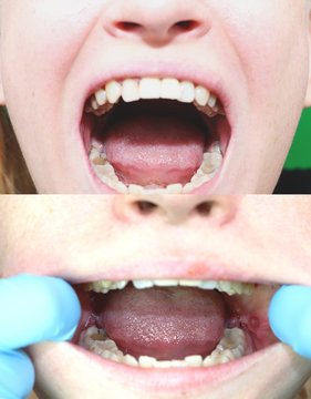 Before and after the operation to remove wisdom teeth - eights. Close-up of wisdom teeth and stitches after removing them