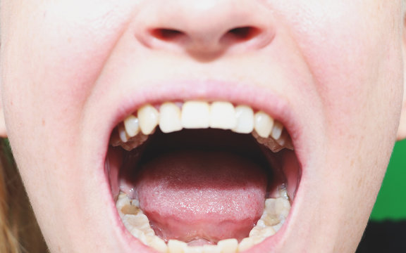 Retinished teeth are wisdom teeth. Preparing for the removal of wisdom teeth