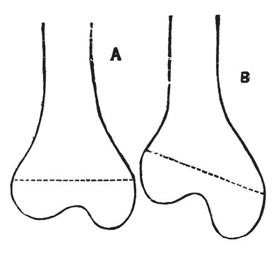 Femur In Knock Knee, Vintage Illustration.