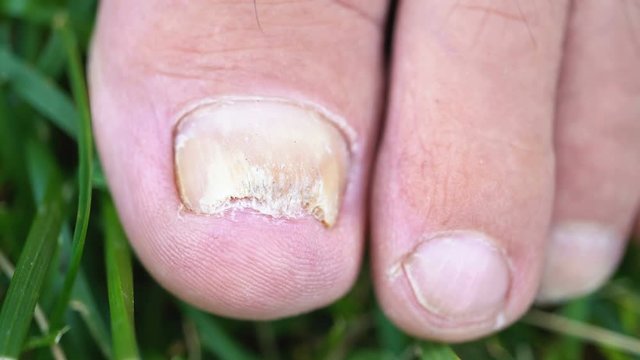 Fungal infection of the nails on the legs of an elderly person close-up.
