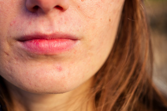 post-acne, scars and red festering pimples on the face of a young woman. concept of skin problems