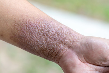A physical of Atopic dermatitis (AD), also known as atopic eczema, is a type of inflammation of the skin (dermatitis).