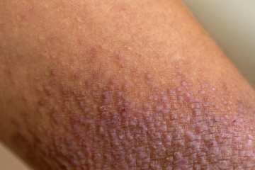 Fototapeta premium A physical of Atopic dermatitis (AD), also known as atopic eczema, is a type of inflammation of the skin (dermatitis).