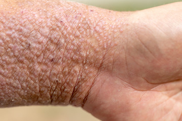 Fototapeta premium A physical of Atopic dermatitis (AD), also known as atopic eczema, is a type of inflammation of the skin (dermatitis).