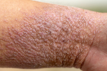 A physical of Atopic dermatitis (AD), also known as atopic eczema, is a type of inflammation of the...