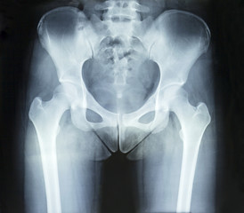 Film x-ray normal pelvis and both hip - obrazy, fototapety, plakaty