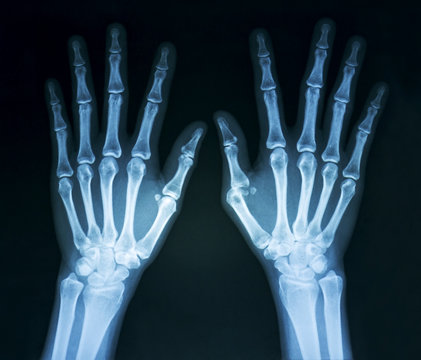 Film x-ray normal both human’s hands