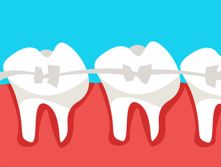 Human teeth with metal braces.Cartoon style.