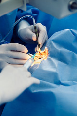 Eye surgery process, treatment of cataract and diopter correction. Surgical implementation of...