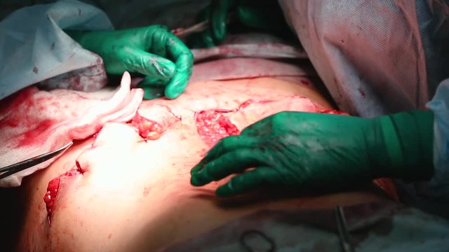 Plastic surgeon performs an operation for abdominoplasty with a transfer of the navel