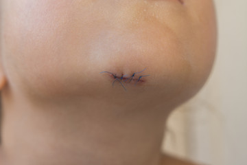 Laceration with stitches of the chin of a child. Close up view. Medical concept.