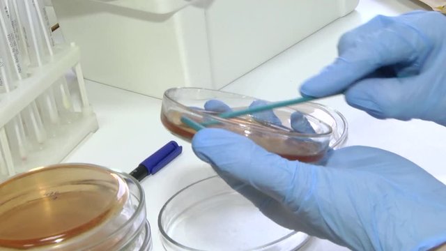 Gynecological smear. Laboratory research. Smear on the flora. The smear is applied to the glass and painted with special dyes.