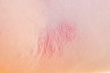 Woman has rash on her arm skin human asian background