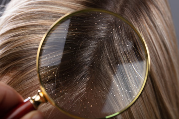 Dandruff In Hair Seen Through Magnifying Glass - obrazy, fototapety, plakaty